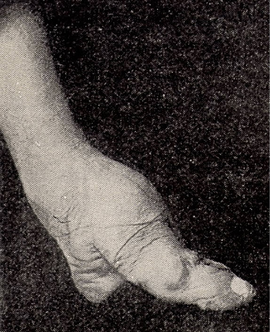 Foot binding left